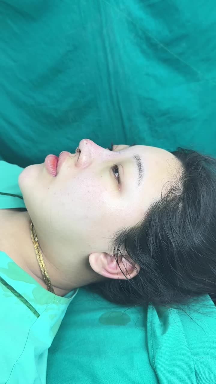 Case mũi cấu trúc surgiform vừa hoàn thành