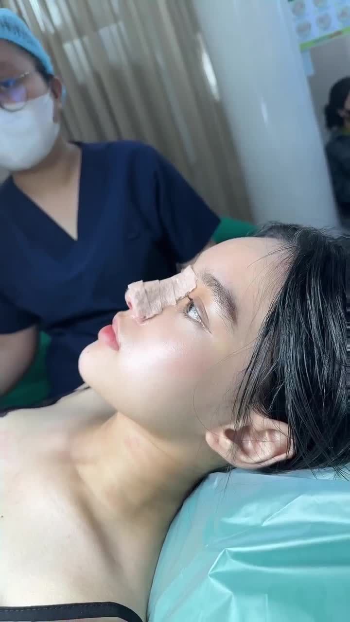 DÁNG MŨI SAU KHI THÁO NẸP SẼ RA SAO???