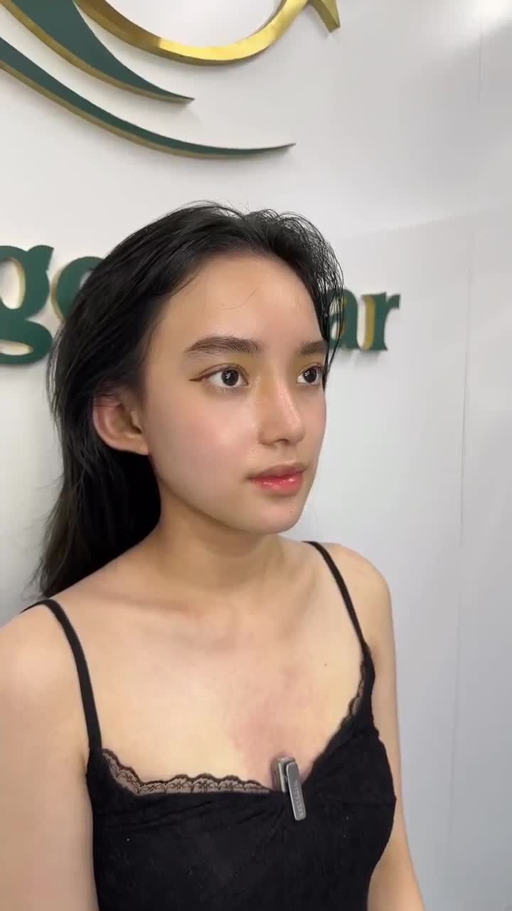 KẾT QUẢ SAU 9 NGÀY NÂNG MŨI CẤU TRÚC CÙNG DR. HOẠT