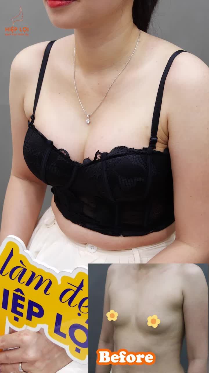 Khách hàng chia sẻ cảm nhận sau khi nâng ngực tại BVTM Hiệp Lợi “Không chỉ đẹp hơn, mà còn được chăm sóc tận tâm từ đầu đến cuối...”
