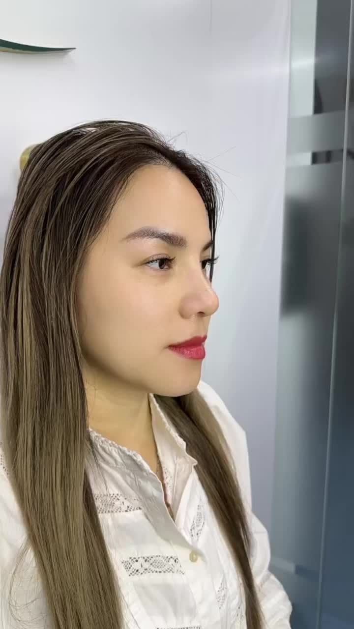 KẾT QUẢ NÂNG MŨI CẤU TRÚC - CẮT CHỈ SAU 10 NGÀY KH. KIM THẢO (VIỆT KIỀU ÚC)