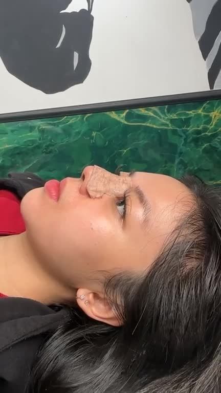 Mũi cấu trúc sau 10 ngày