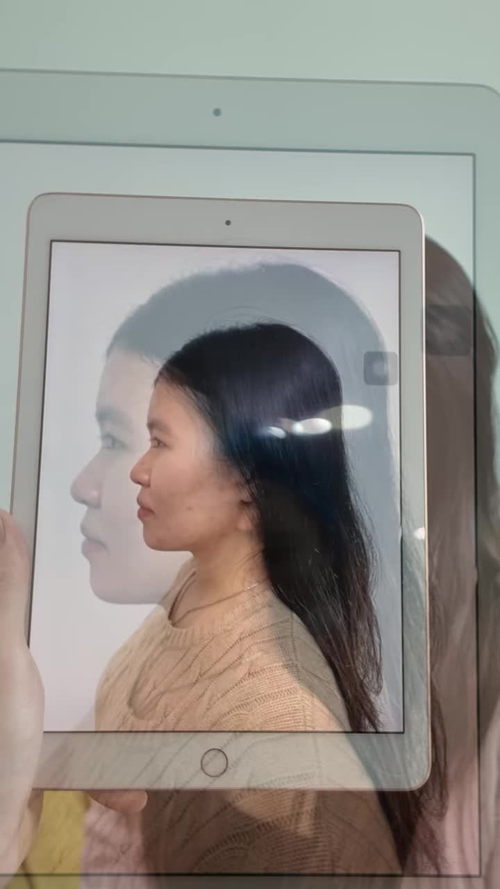 "Say bye" mũi tẹt! Chiêm ngưỡng góc nghiêng THẦN THÁNH của khách hàng sau 02 tuần nâng mũi tại thẩm mỹ Tuấn Anh.