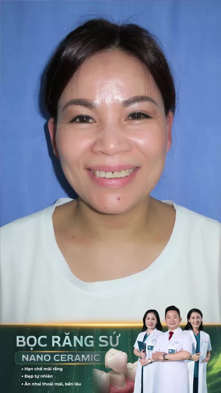 Hết hô, tự tin hơn sau bọc răng sứ