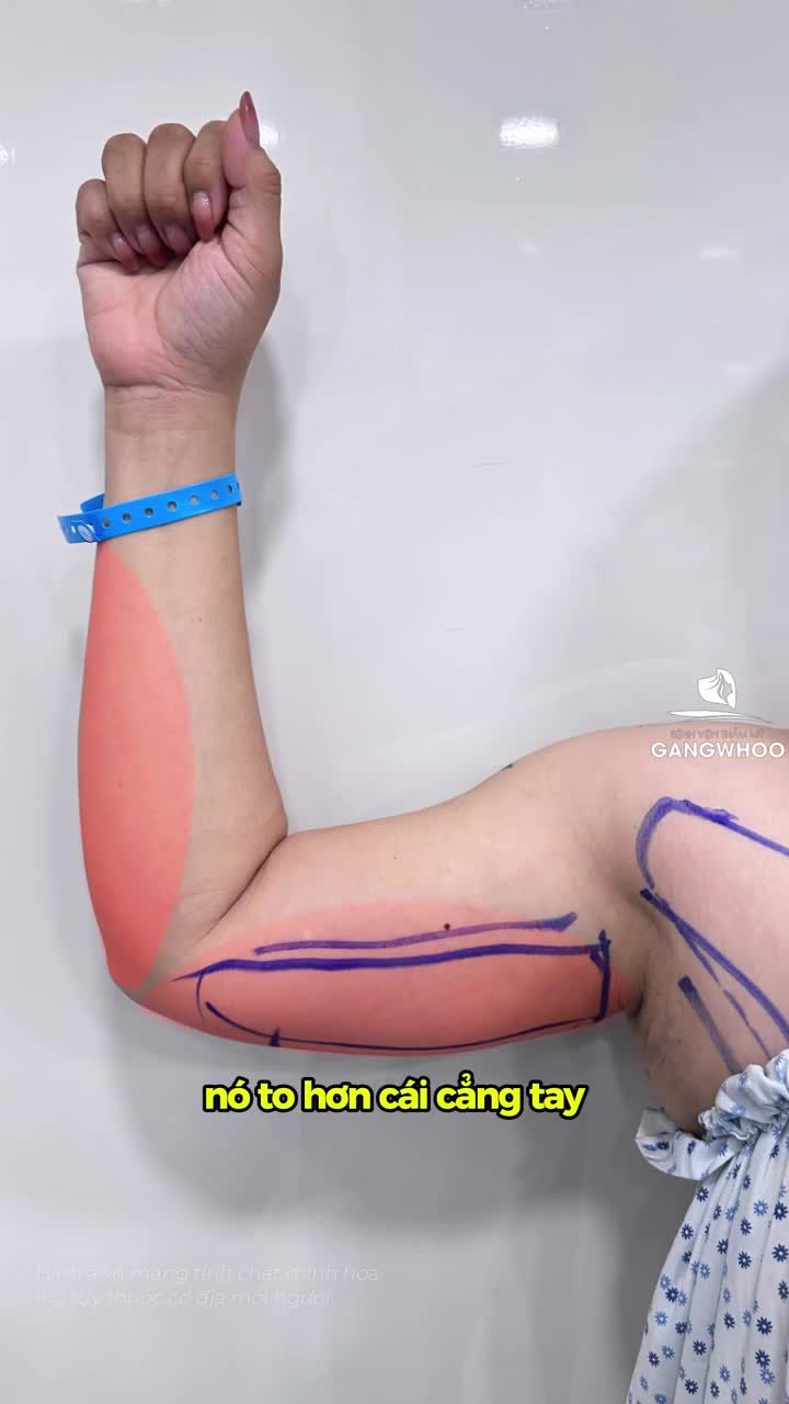 Kết quả hút mỡ bắp tay của chị khách việt kiều sau 30 phút và  sau 1 tuần