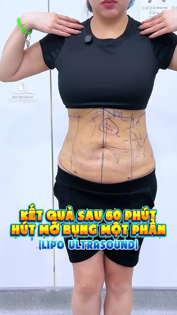 Việt kiều Úc bay về Việt Nam làm dịch vụ hút mỡ bụng một phần (Lipo Ultrasound) - Kết quả vòng eo thon gọn, hậu phẫu nhẹ nhàng