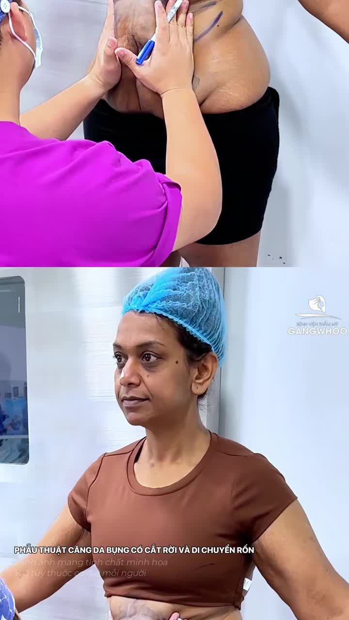 Khách hàng Úc đến Gangwhoo làm dịch vụ phẫu thuật căng da bụng có cắt rời và di chuyển rốn kết hợp công nghệ nội soi 4k - hỗ trợ bác sĩ quan sát chính xác từng bó cơ, từng dây thần kinh, đảm bảo độ an toàn tuyệt đối.