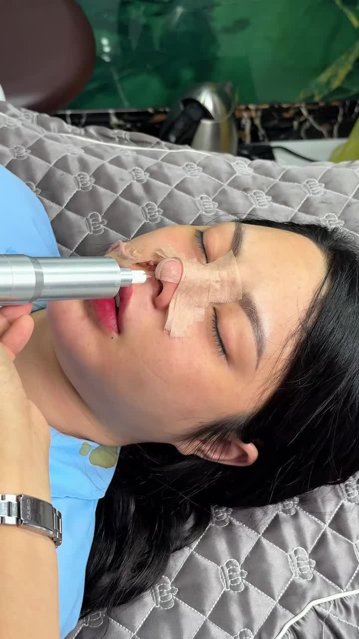 Mũi đẹp ngay sau phẫu thuật với kỹ thuật nâng độc quyền!!
