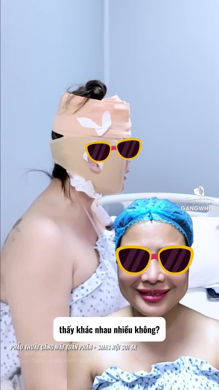 Khách hàng phải WOW trước kết quả căng da sửa lại nhờ phương pháp phẫu thuật chỉnh sửa các biến chứng sau mổ căng da mặt + Smas nội soi 4K