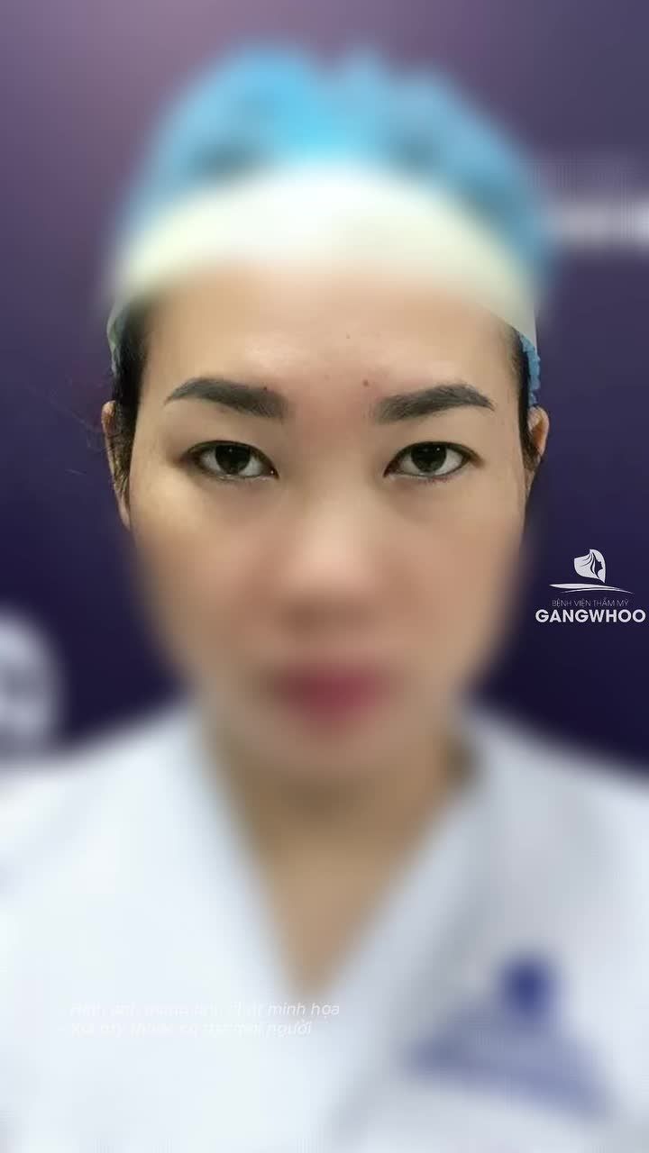 Cắt mí Eyelid, loại bỏ da chùng tinh tế, tạo hình hai mí rõ nét. Đường mí đều và đẹp, hạn chế sưng bầm tối đa, khách hàng cảm thấy nhẹ nhàng và không đau...