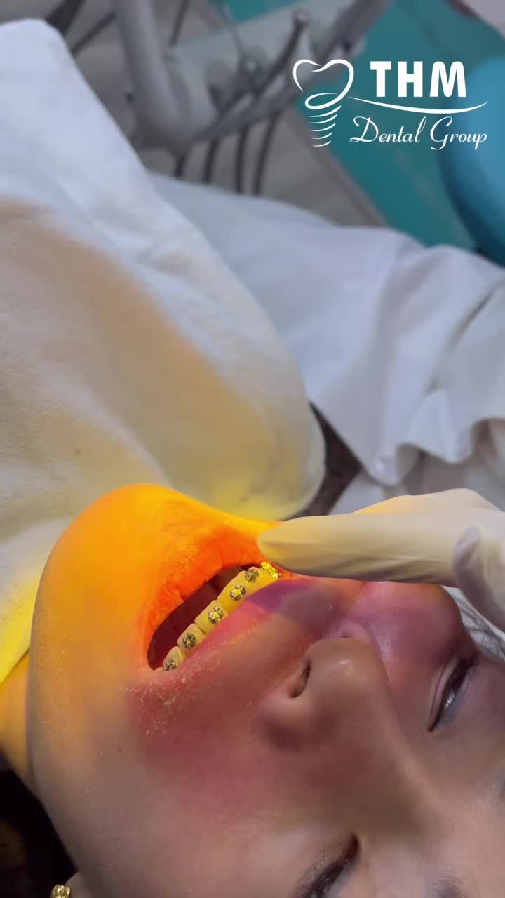 “Mỗi lần hẹn, bác sĩ chỉ gắn một hàm mắc cài – để bệnh nhân dễ thích nghi hơn, ăn uống thoải mái hơn và vẫn đảm bảo tiến độ chỉnh nha.”