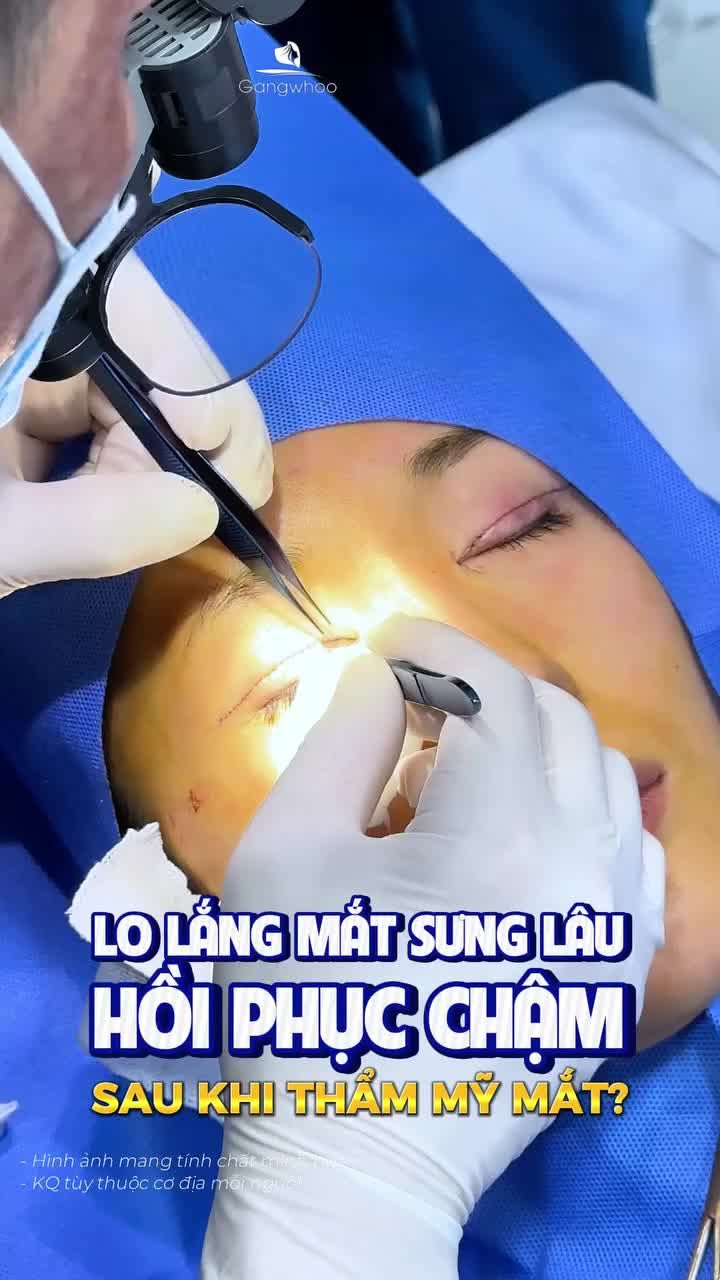 Bạn lo mắt sưng bầm lâu, e ngại quá trình thực hiện hay mất nhiều thời gian hồi phục. Cùng nghe chia sẻ từ khách hàng tại Gangwhoo nhé.