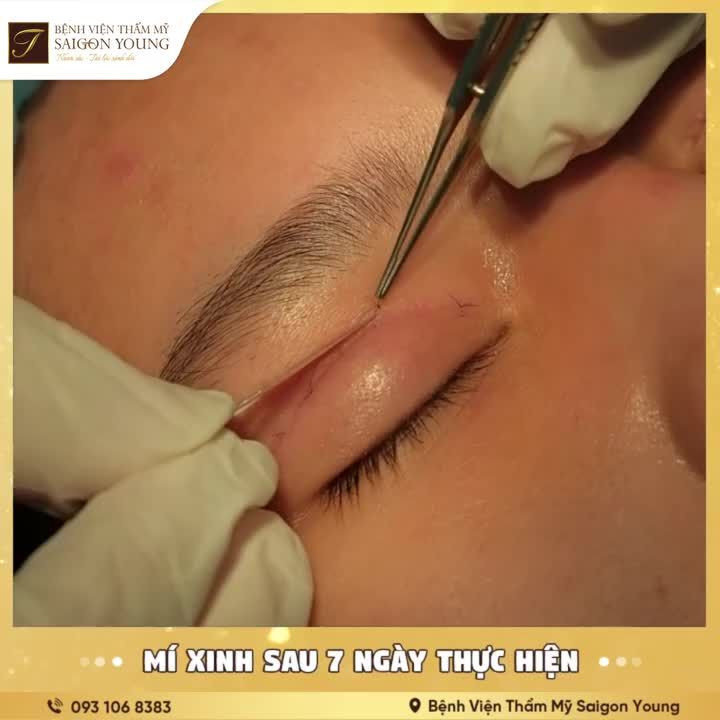 Cắt chỉ mí mắt  Mí xinh sau 7 ngày thực hiện. Kết quả lung linh sau Combo Cắt mí Nâng mũi tại Saigon Young.