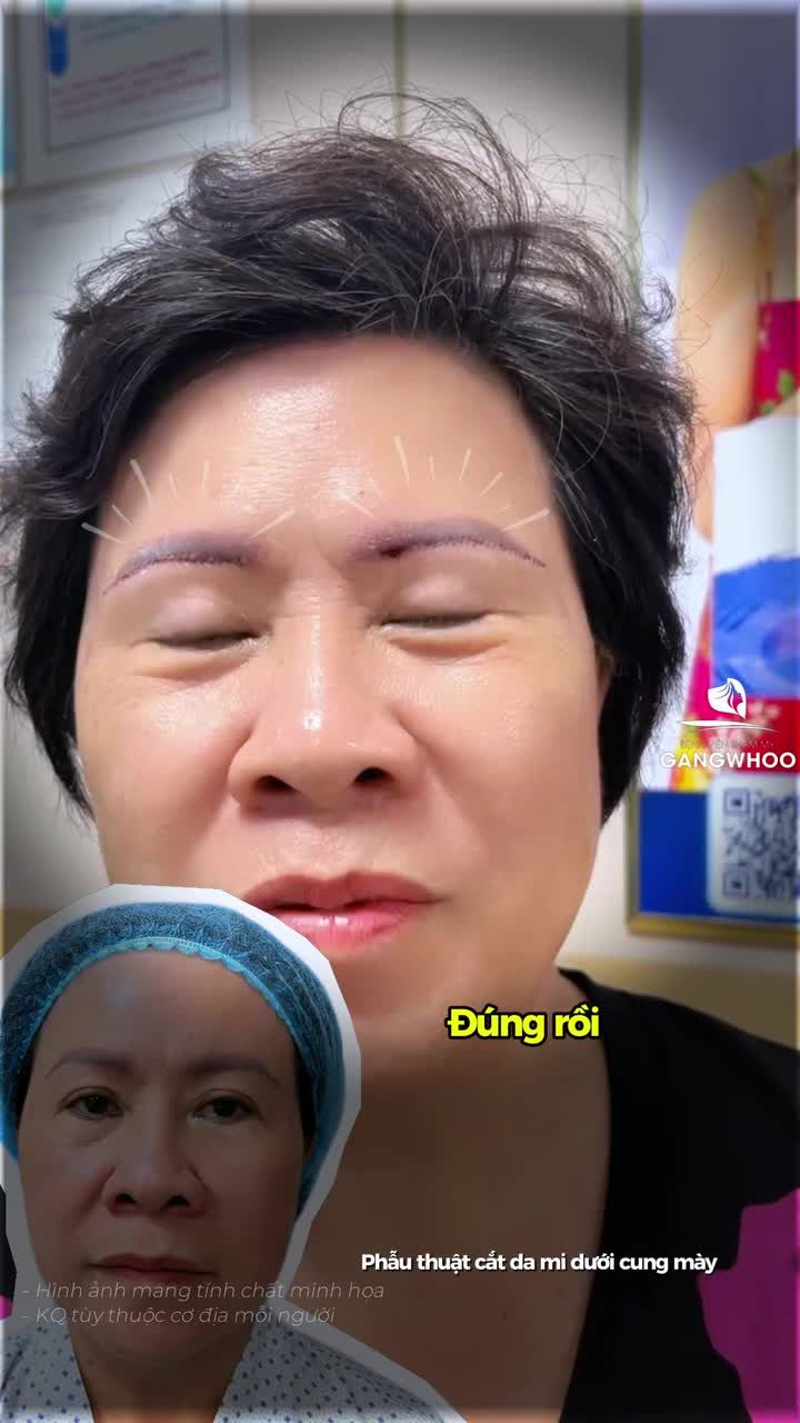 Sau 45 phút thực hiện phương pháp treo cung mày, giúp loại bỏ da chùng mi mắt qua đường chân mày, lấy lại đôi mắt tươi trẻ và rõ mí.