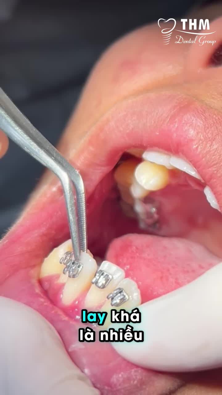 Tại sao cần nâng khớp khi niềng răng?