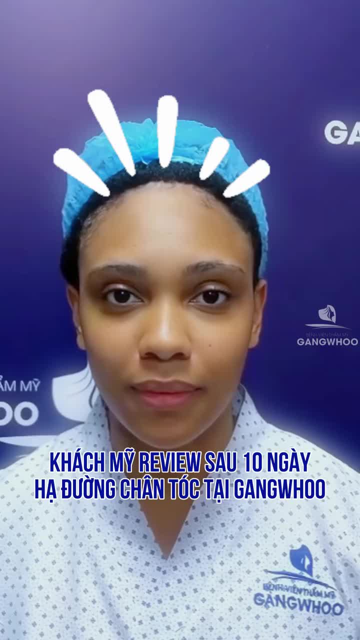 Khách Mỹ review sau 10 ngày hạ đường chân tóc nội soi vi phẫu