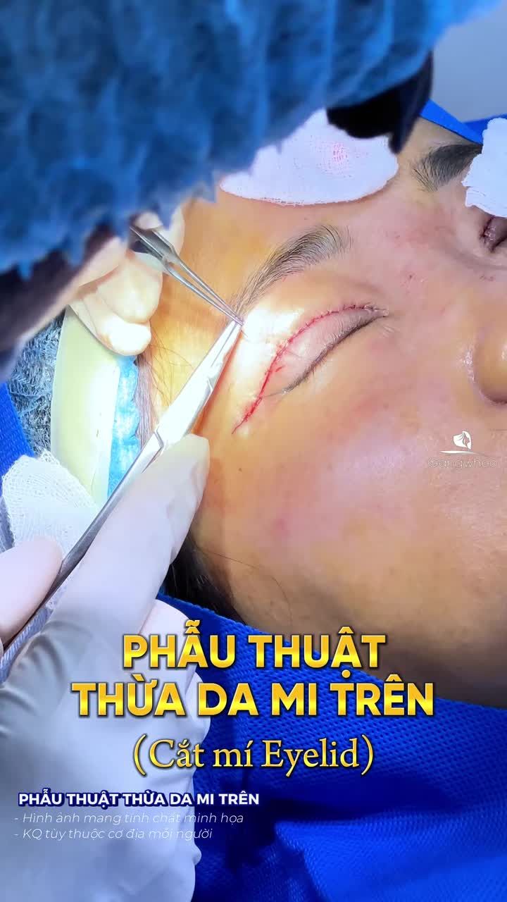 Đường khâu mảnh giúp hạn chế tổn thương các mô xung quanh và rút ngắn thời gian hồi phục.