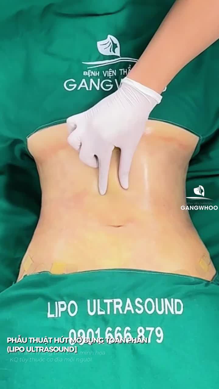 Da thừa chùng nhão nhẹ sau 60 phút phẫu thuật hút mỡ bụng toàn phần (Lipo Ultrasound)