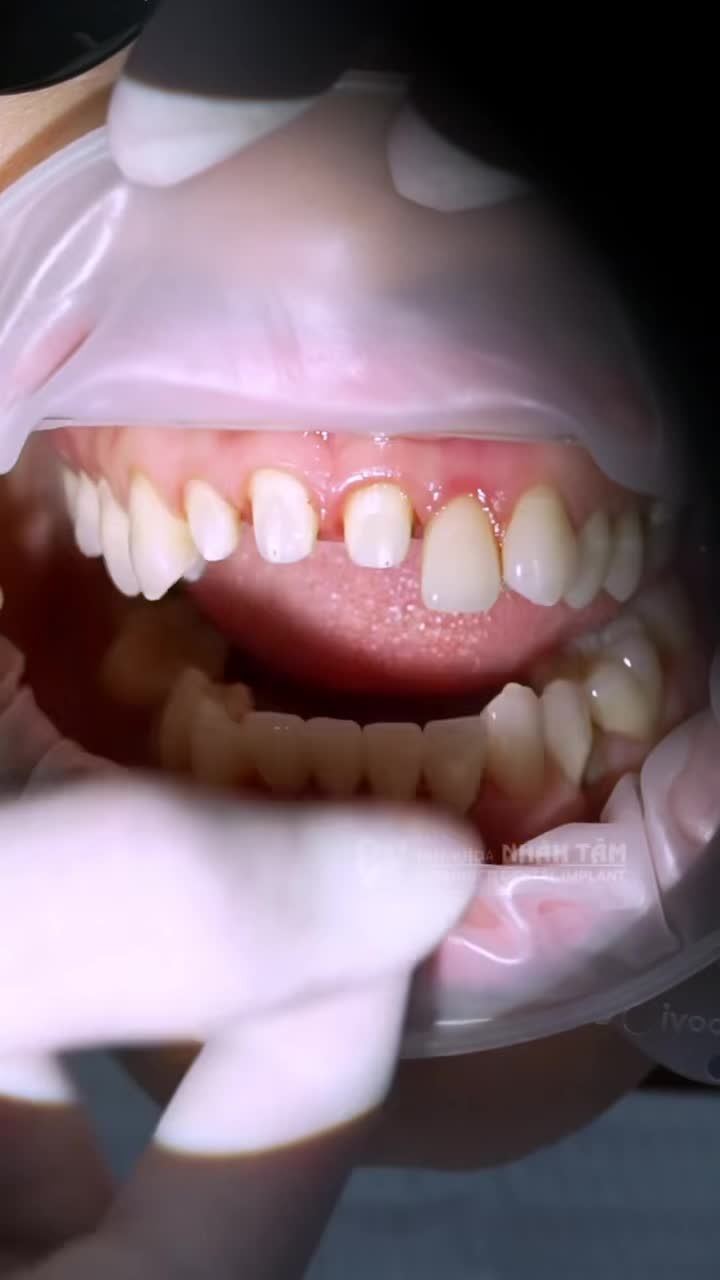 KHẮC PHỤC RĂNG SỨ LỖI, TÁI TẠO NỤ CƯỜI TỰ TIN