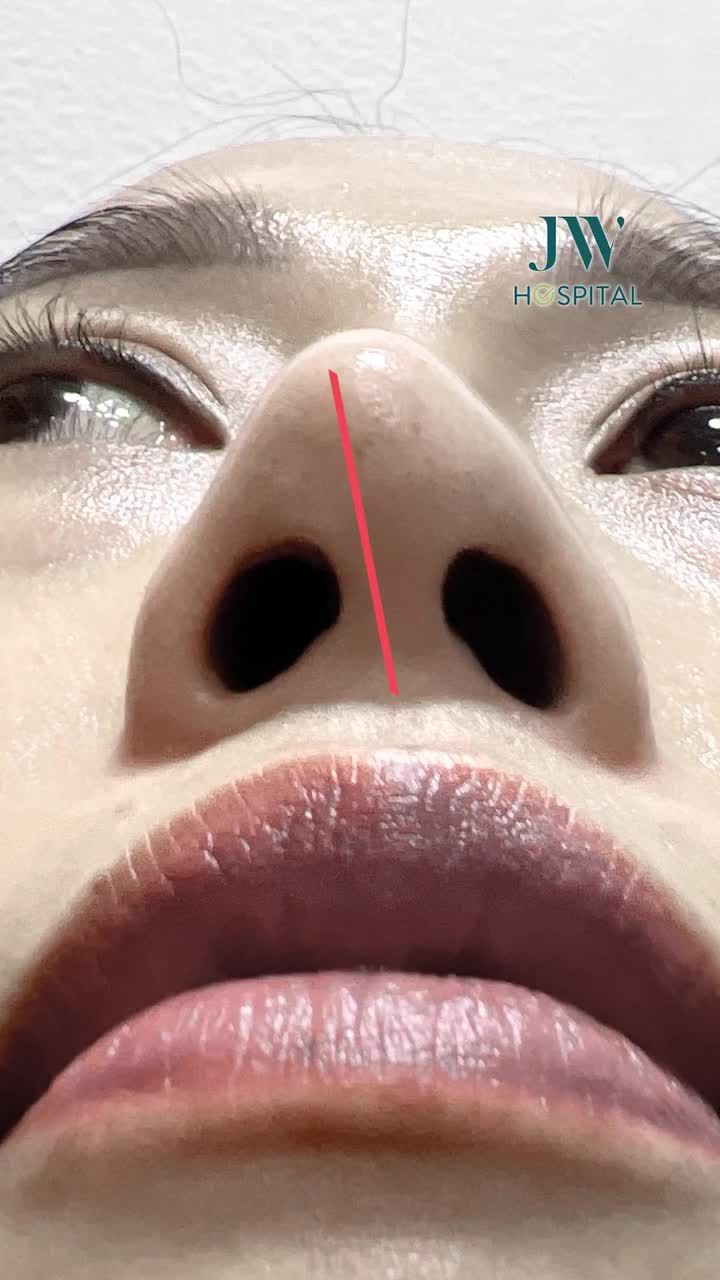 NGOẠN MỤC: NỮ VIỆT KIỀU SINGAPORE THOÁT KIẾP 10 NĂM MŨI LỘ SÓNG, VẸO LỆCH VỚI NÂNG MŨI S LINE TẠI JW