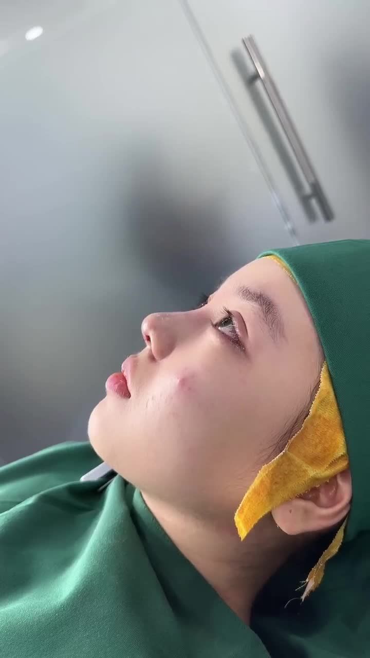 KẾT QUẢ NÂNG MŨI CẤU TRÚC - KHẮC PHỤC MŨI GỒ KH. HUỲNH NHƯ