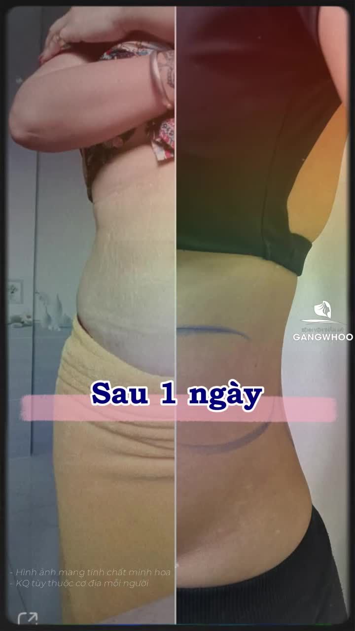 Khách hàng nước ngoài giảm mỡ tại Gangwhoo