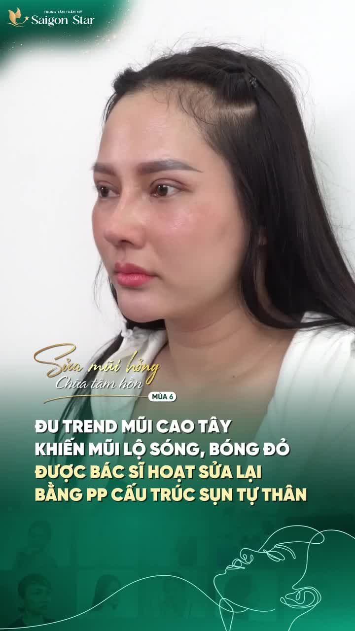 CHỊ KHÁCH ĐU TREND MŨI CAO TÂY GẶP PHẢI BIẾN CHỨNG LỘ SÓNG, BÓNG ĐỎ ĐẦU MŨI  VỚI PHƯƠNG PHÁP TÁI CẤU TRÚC ĐỘC QUYỀN - DR HOẠT ĐÃ GIÚP CHỊ TÌM LẠI DÁNG MŨI MỚI