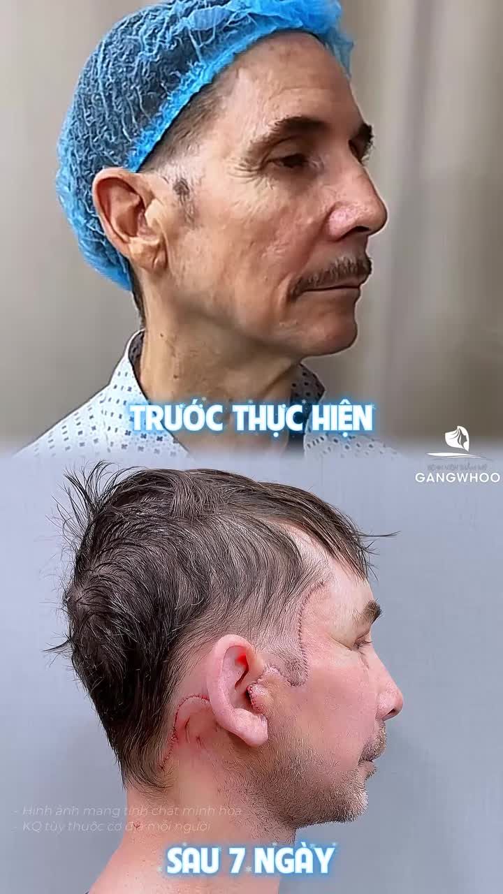 Kết quả sau 7 ngày phẫu thuật căng mặt toàn phần + Smas nội soi 4K