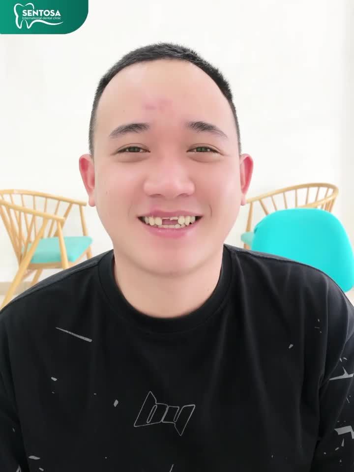 ƯU ĐÃI BỌC RĂNG SỨ ĐẾN 50% - ĐIỀU TRỊ DỨT ĐIỂM CÁC BỆNH LÝ