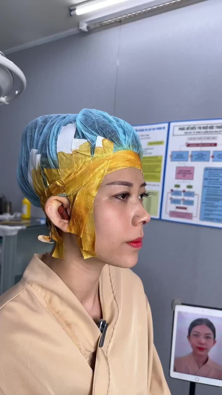 KẾT QUẢ NÂNG MŨI CẤU TRÚC - KHẮC PHỤC MŨI GỒ KH. THẢO VY