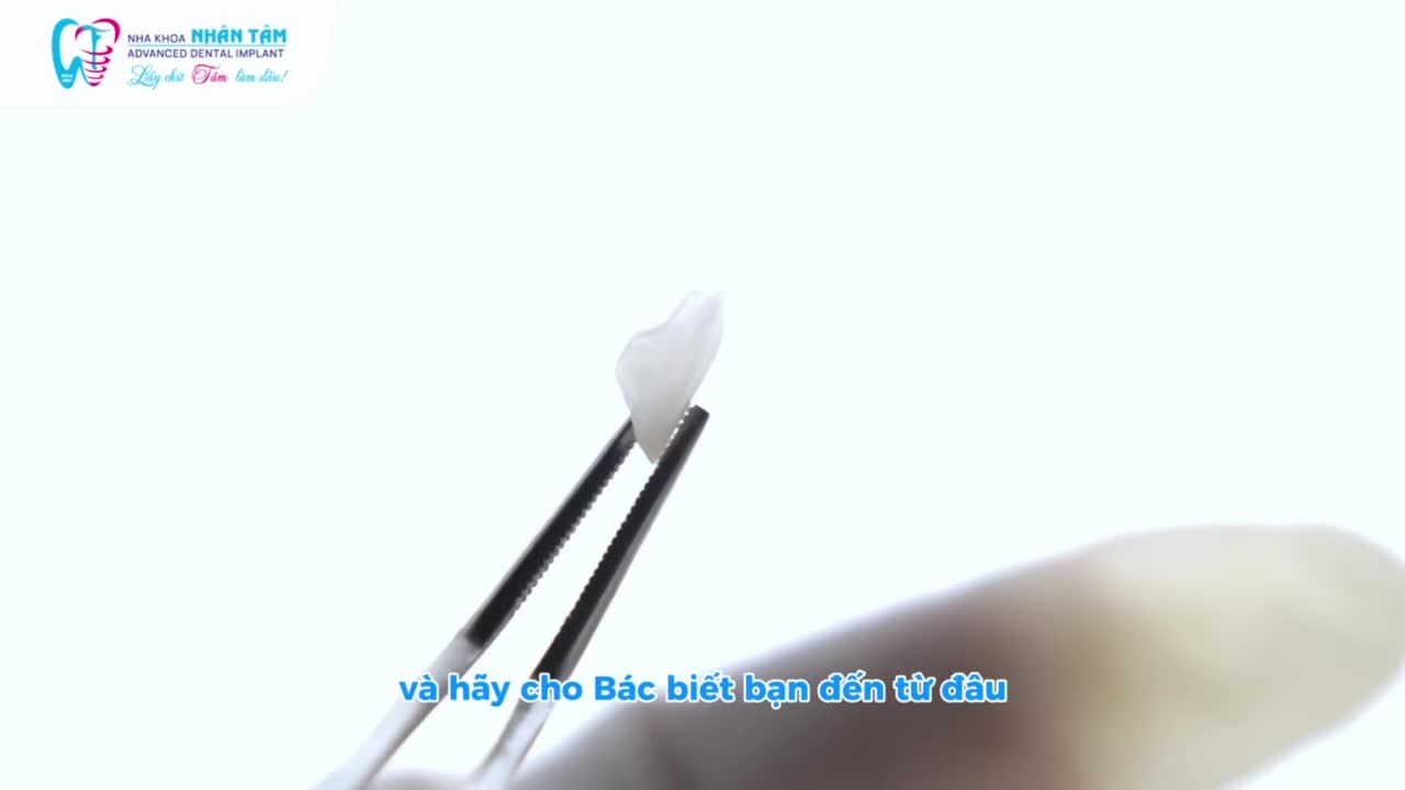 TRẢI NGHIỆM SỨ VENEER TOÀN HÀM – KHÁCH HÀNG TRUNG QUỐC TỰ TIN VỚI NỤ CƯỜI MỚI