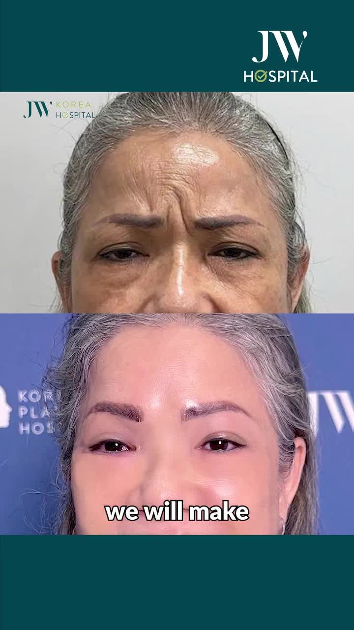 CẮT CHÂN MÀY, BỎ DA: BÁC SĨ JW GIÚP VIỆT KIỀU MỸ U50 TRẺ 20 TUỔI