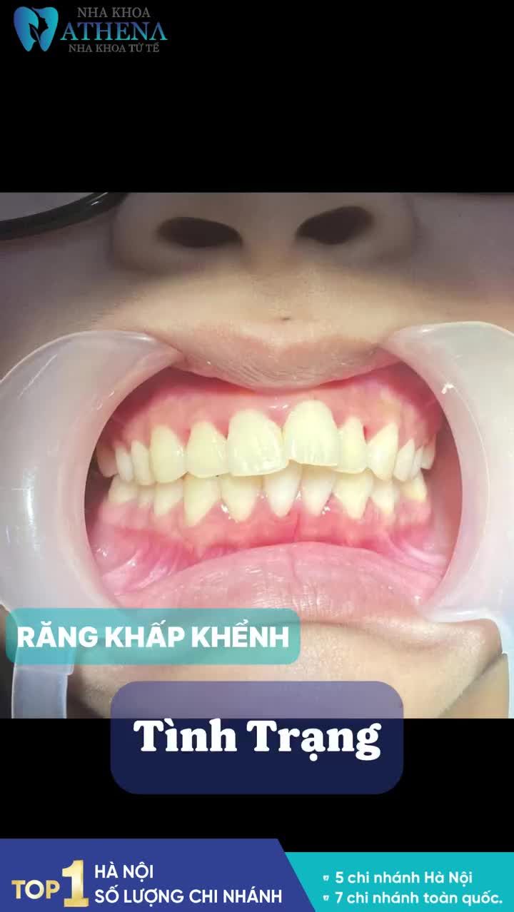 KHÁNH CHI 2008 –  “LÀM ĐẸP NỤ CƯỜI” VỚI MẮC CÀI SỨ TẠI ATHENA