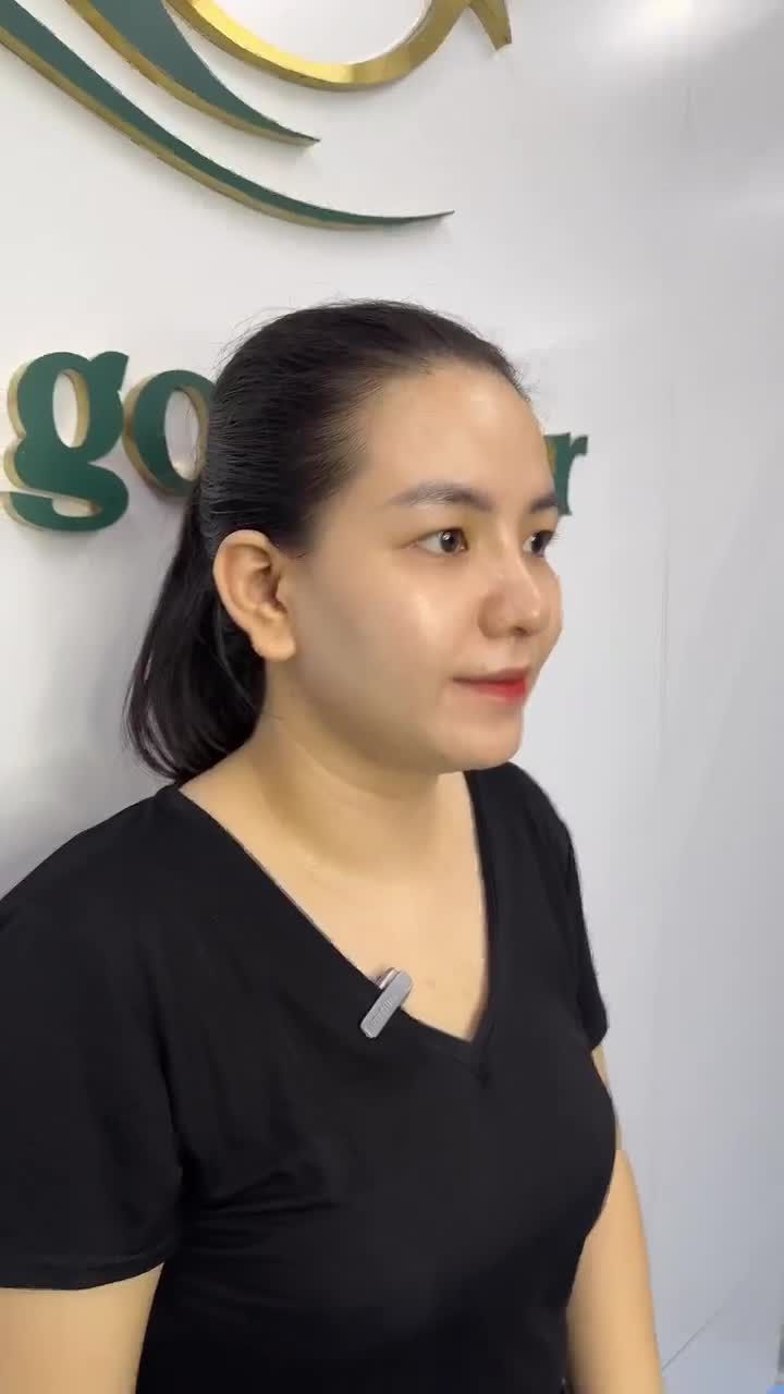 KẾT QUẢ SAU 10 NGÀY NÂNG MŨI CẤU TRÚC DR.HOẠT