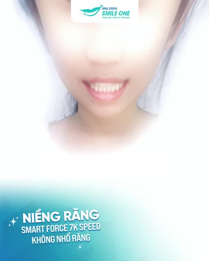 Chào các cô chú nhé, con tháo niềng, con xinh trước đây Hi vọng các cô chú cũng sớm được tháo niềng như con