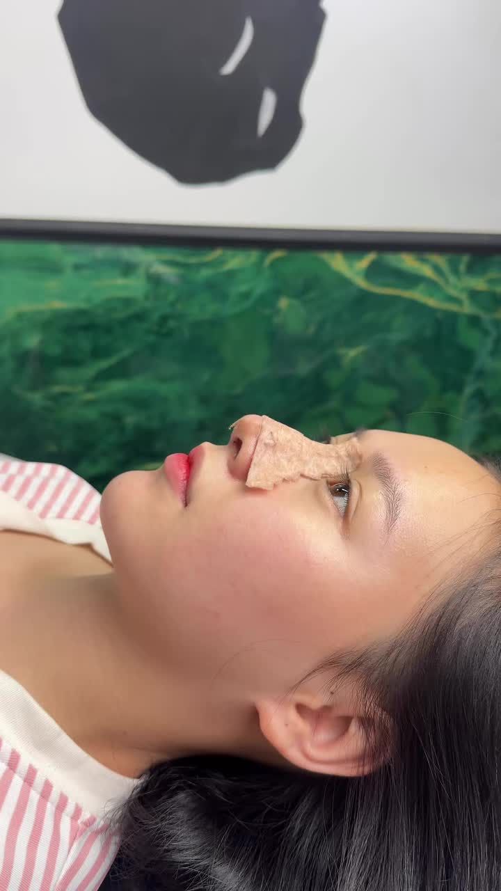 Case mũi cấu trúc surgiform được 10 ngày