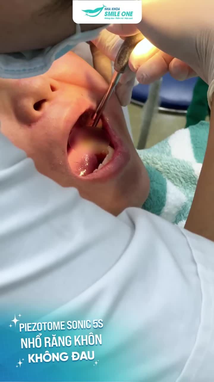 Mọi người cứ nghĩ nhổ răng khôn đau lắm, thực tế như nào nhỉ?