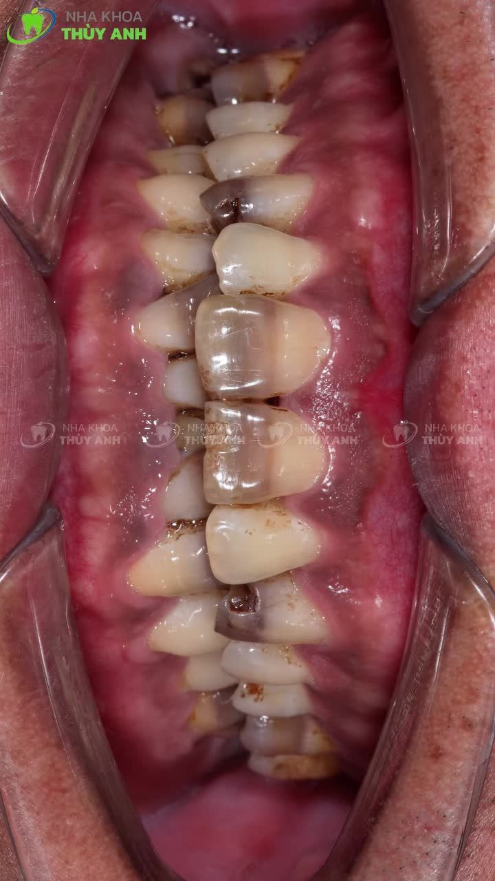 BỌC SỨ THẨM MỸ - NÂNG TẦM LỊCH LÃM, THU HÚT PHÚ QUÝ