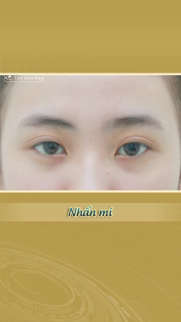 Ngại can thiệp phẫu thuật nhưng vẫn muốn có mắt hai mí rõ nét