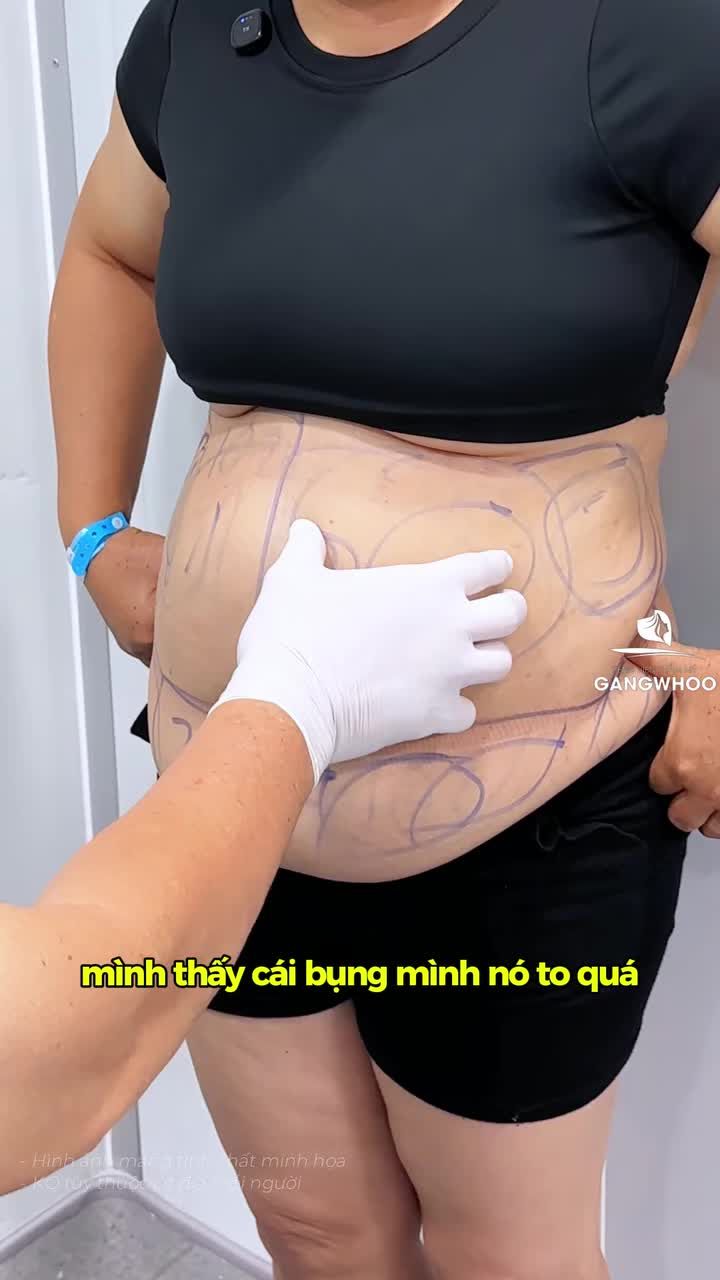 Dù gặp khó khăn với chiếc bụng, to, sồ đến đâu thì các khách hàng Gangwhoo đều có những trải nghiệm hài lòng sau khi làm dịch vụ phẫu thuật hút mỡ bụng toàn phần (Lipo Ultrasound)