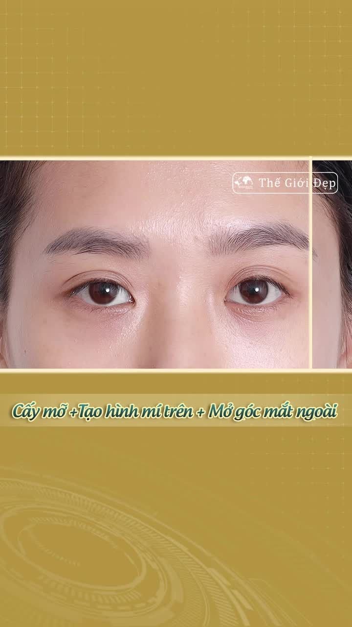 Cắt mí thôi chưa đủ, Cô nàng “nâng cấp” ánh nhìn rạng rỡ hơn thế nào khi kết hợp mở góc mắt ngoài và cấy mỡ mí mắt?