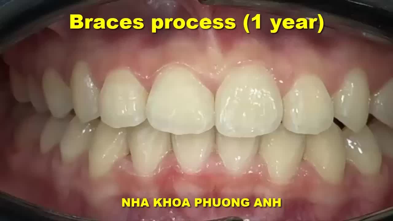 Chinh nha không mắc cài