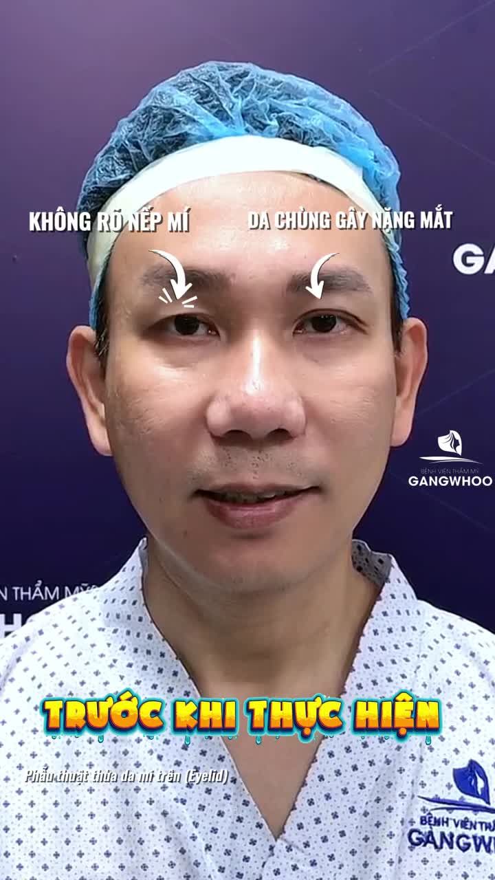 Chỉ sau 7 ngày, các khuyết điểm vùng mắt đã được khắc phục. Cùng chờ thêm kết quả hoàn thiện tiếp theo nhé..!