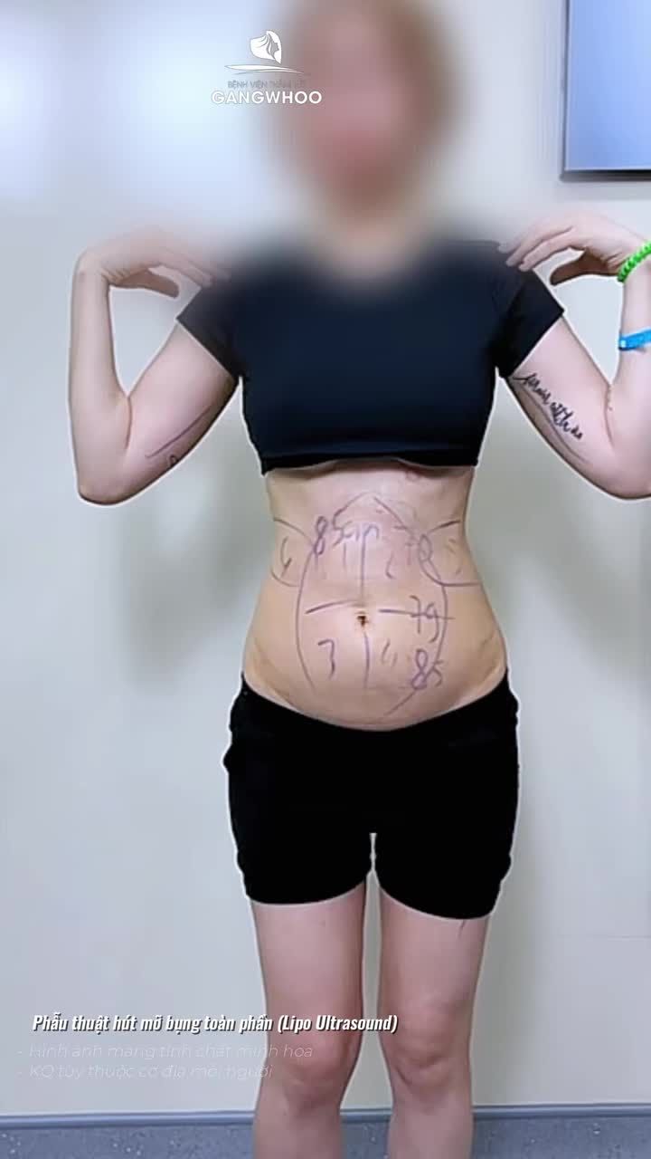 Lắng nghe chia sẻ của chị khách sau 1 tháng tân trang vòng 2 (Phẫu thuật hút mỡ bụng toàn phần)