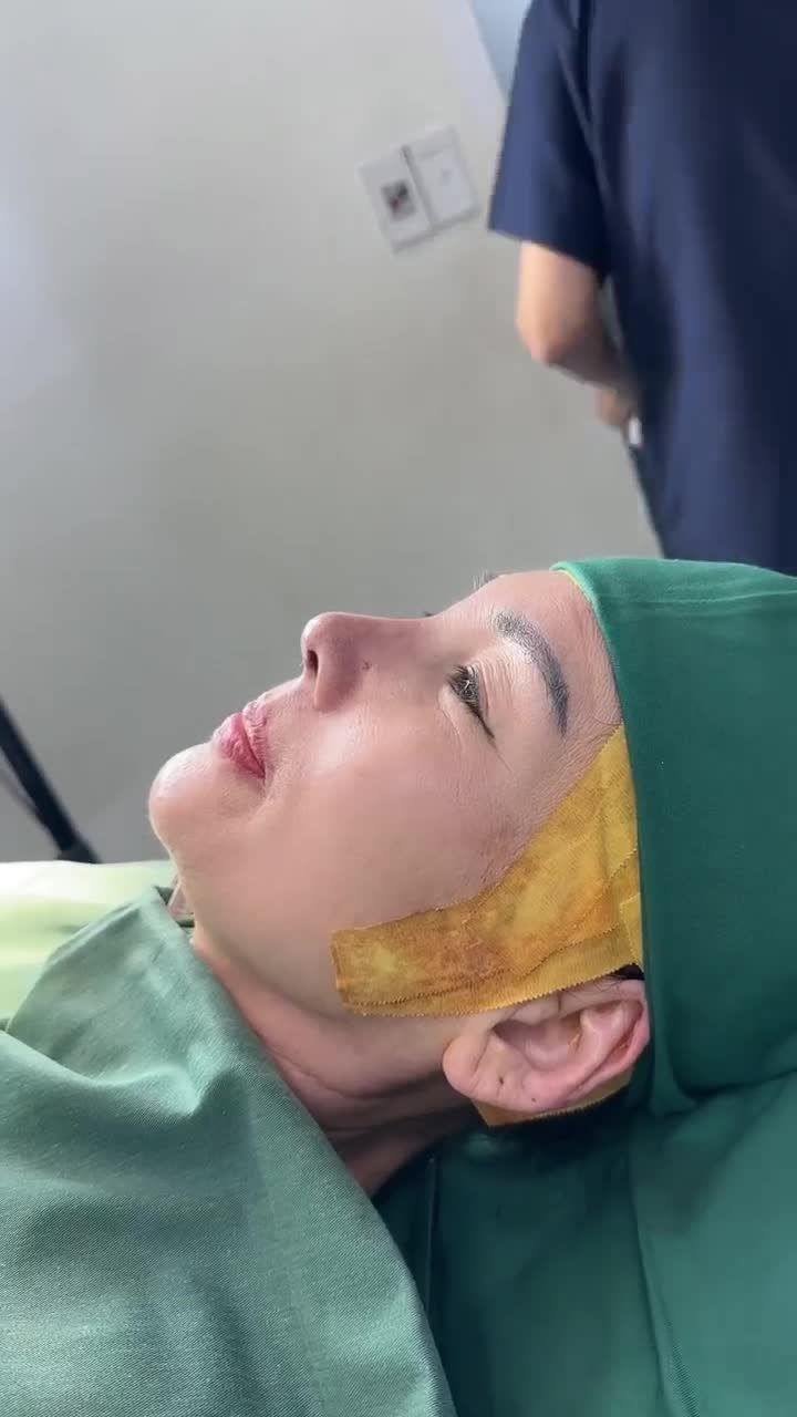 KẾT QUẢ SAU 60 PHÚT THỰC HIỆN NÂNG MŨI CẤU TRÚC TẠI SAIGON STAR KH. KONG SOHN (HÀN QUỐC)