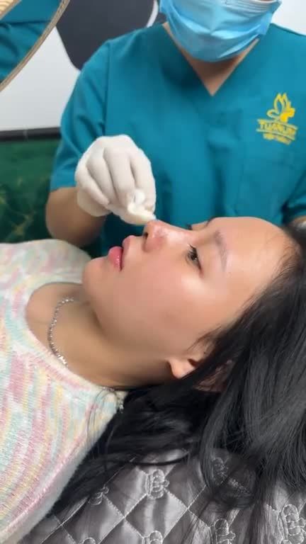Mũi cấu trúc 5 ngày