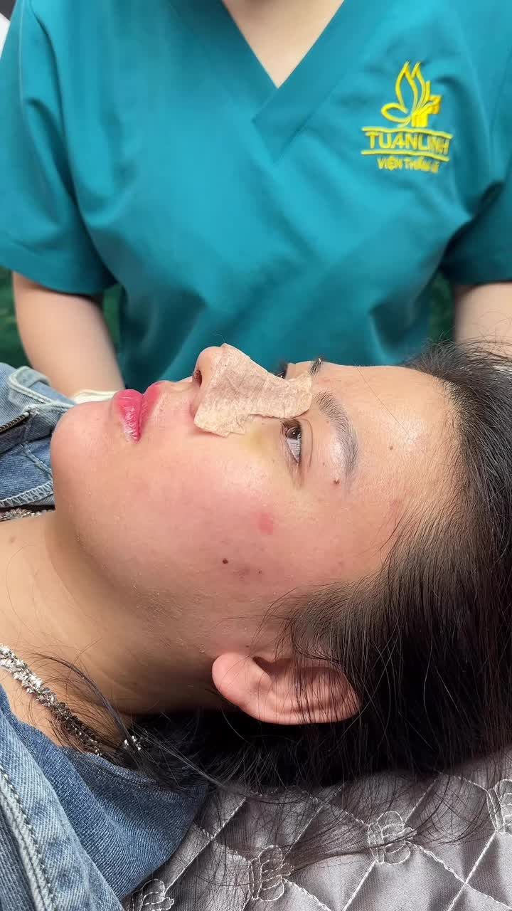 Mũi cấu trúc sau 10 ngày