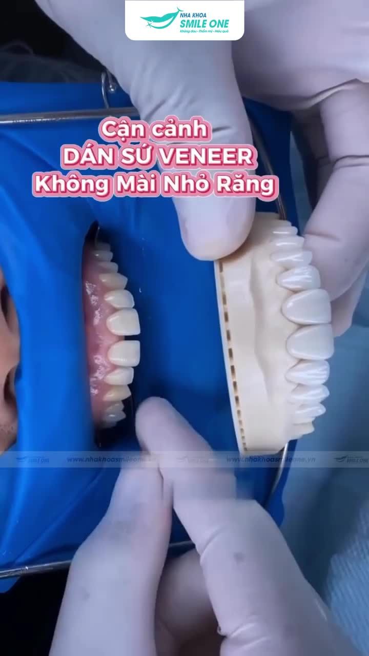 Khách hàng cứ hỏi, dán sứ veneer không mài nhỏ răng có thật không thì đây là câu trả lời nha!