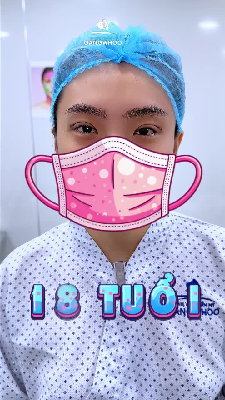 18 tuổi – mẹ dắt đi cắt mí tại Gangwhoo.