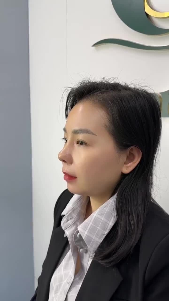 CẬN CẢNH DÁNG MŨI CẤU TRÚC DR.HOẠT SAU 10 NGÀY
